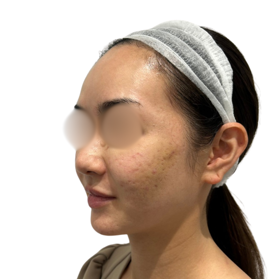 サブシジョン（クレーター治療）